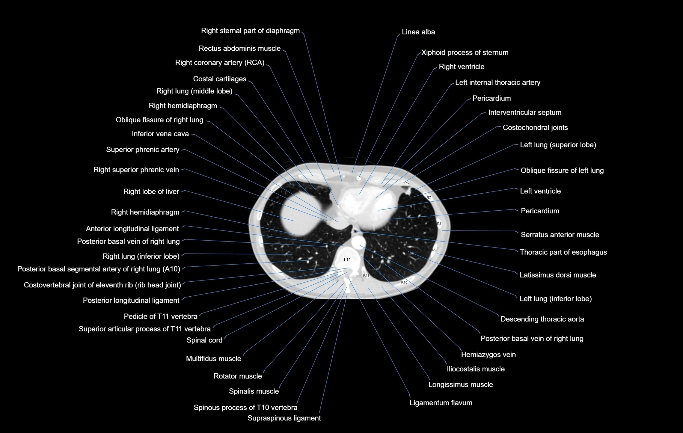 CT chest (thorax) lung window window labelled axial cross sectional anatomy radiology image-00095.webp